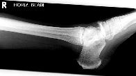 Midtarsal fracture-dislocation